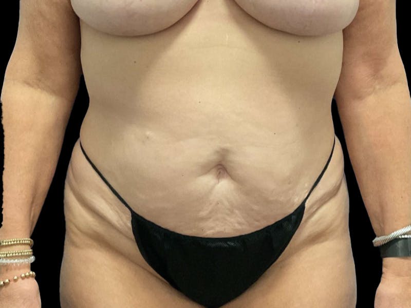 Tummy Tuck by Dr. Booth Before & After Gallery - Patient 763778 - Image 1
