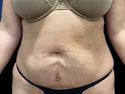 Tummy Tuck by Dr. Booth Before & After Gallery - Patient 426555 - Image 1