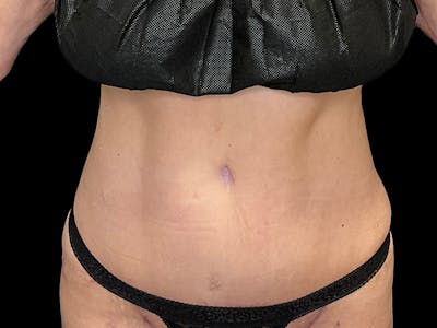 Tummy Tuck by Dr. Booth Before & After Gallery - Patient 426555 - Image 2