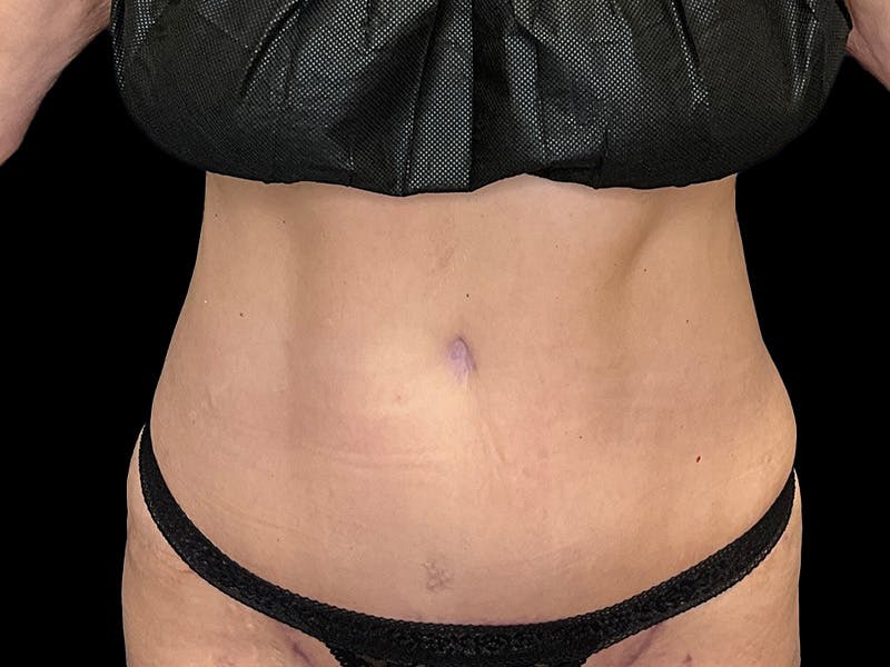 Tummy Tuck by Dr. Booth Before & After Gallery - Patient 426555 - Image 2