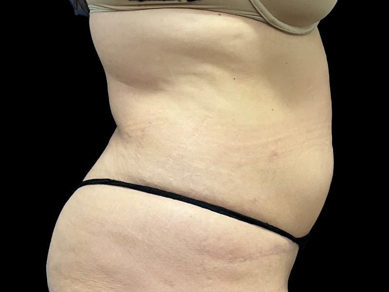 Tummy Tuck by Dr. Booth Before & After Gallery - Patient 426555 - Image 3
