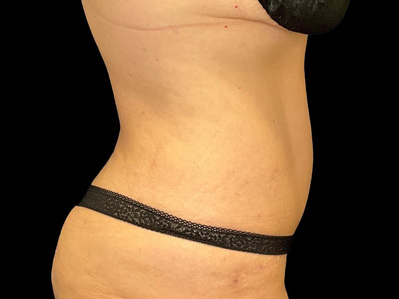 Tummy Tuck by Dr. Booth Before & After Gallery - Patient 426555 - Image 4