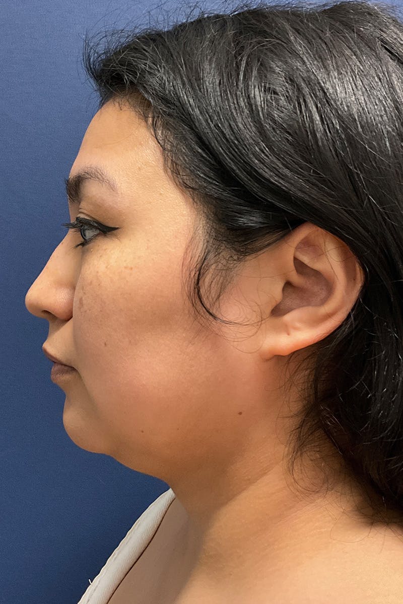 Submental Liposuction by Dr. Booth Before & After Gallery - Patient 255813 - Image 1