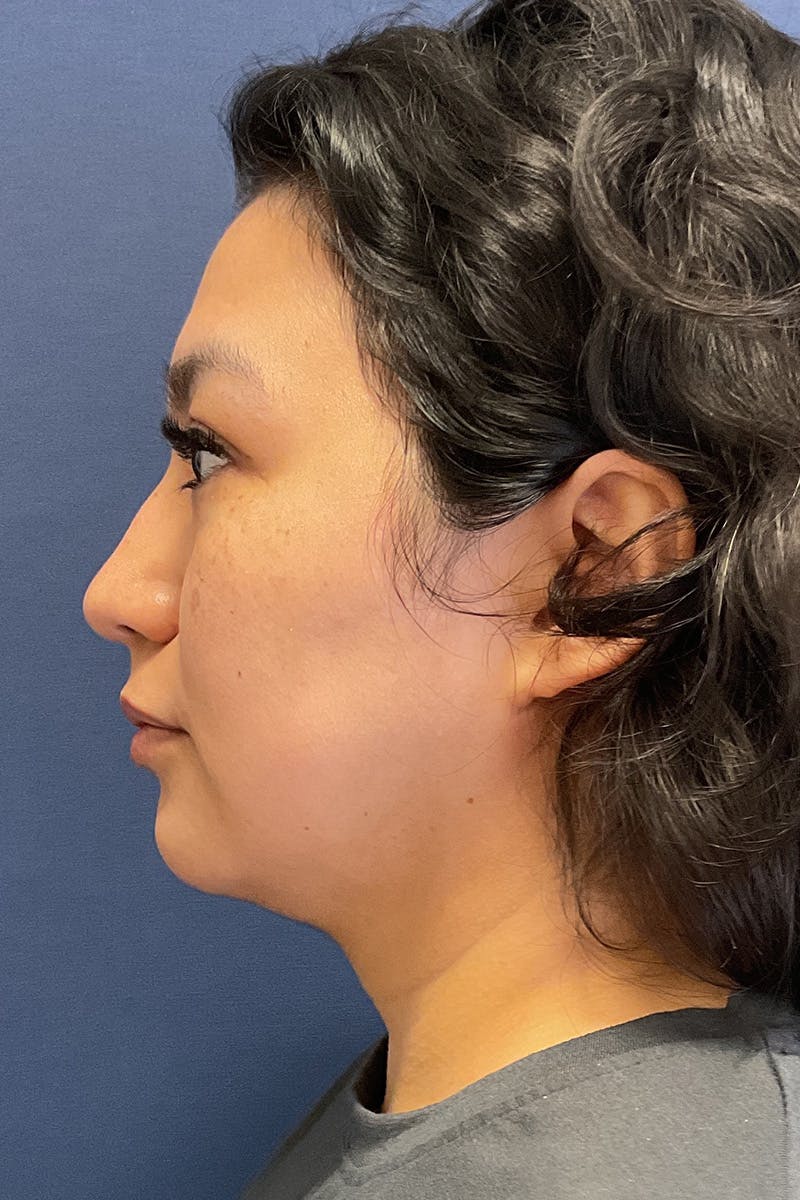 Submental Liposuction by Dr. Booth Before & After Gallery - Patient 255813 - Image 2