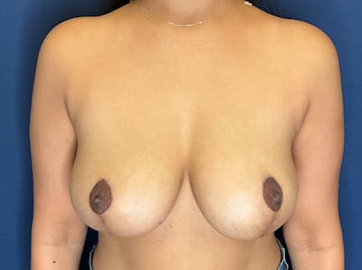 Breast Reduction by Dr. Booth Before & After Gallery - Patient 179630 - Image 2