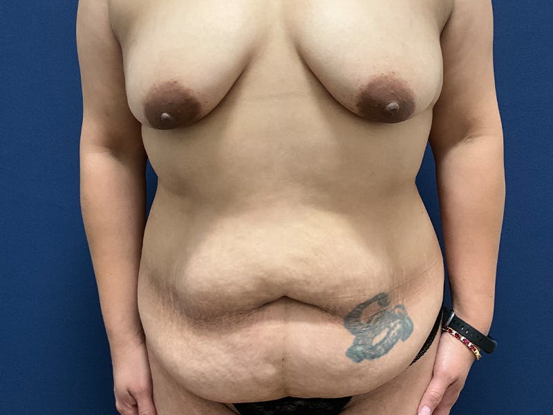 Tummy Tuck by Dr. Booth Before & After Gallery - Patient 238149 - Image 1
