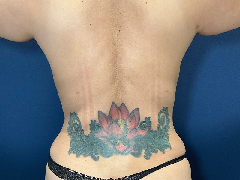 Tummy Tuck by Dr. Booth Before & After Gallery - Patient 238149 - Image 6