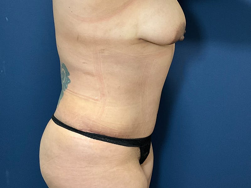 Tummy Tuck by Dr. Booth Before & After Gallery - Patient 238149 - Image 4
