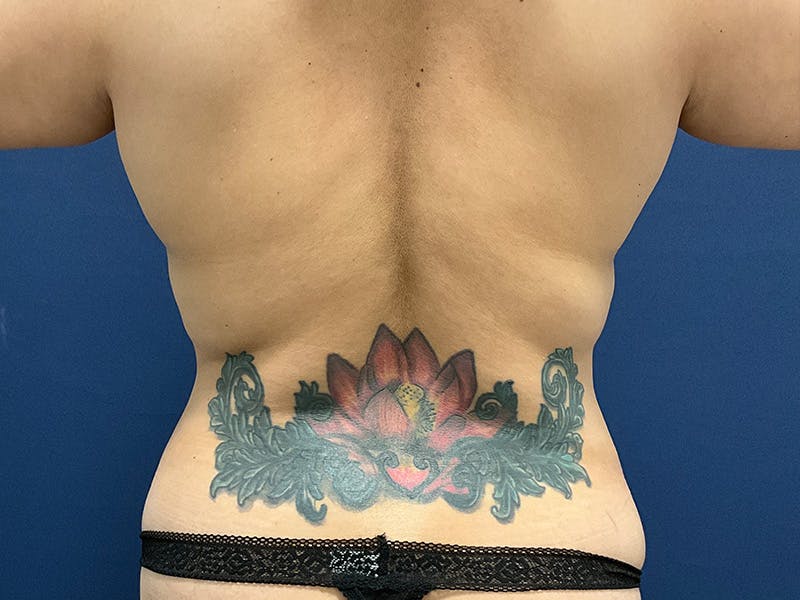 Tummy Tuck by Dr. Booth Before & After Gallery - Patient 238149 - Image 5