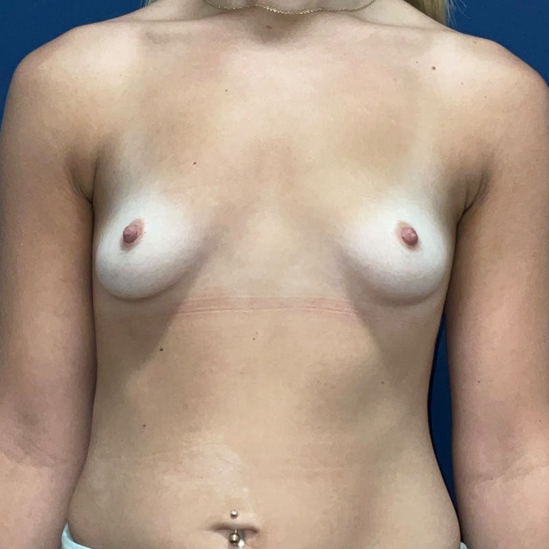 Breast Augmentation by Dr. Haydon Before & After Gallery - Patient 687336 - Image 1