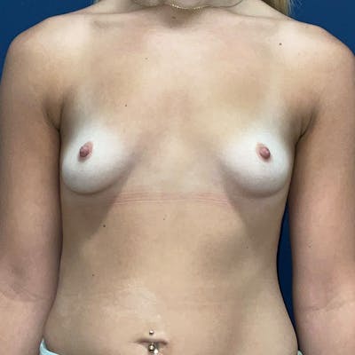 Breast Augmentation by Dr. Haydon Before & After Gallery - Patient 687336 - Image 1