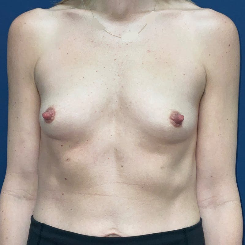 Breast Augmentation by Dr. Haydon Before & After Gallery - Patient 987721 - Image 1
