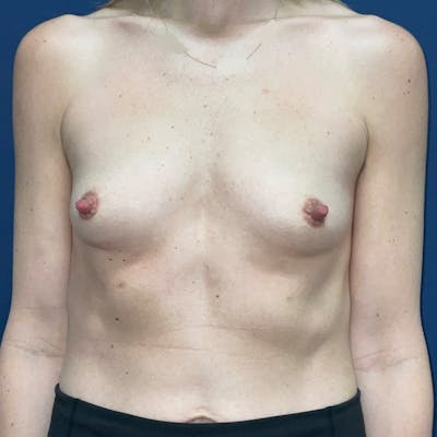 Breast Augmentation by Dr. Haydon Before & After Gallery - Patient 987721 - Image 1