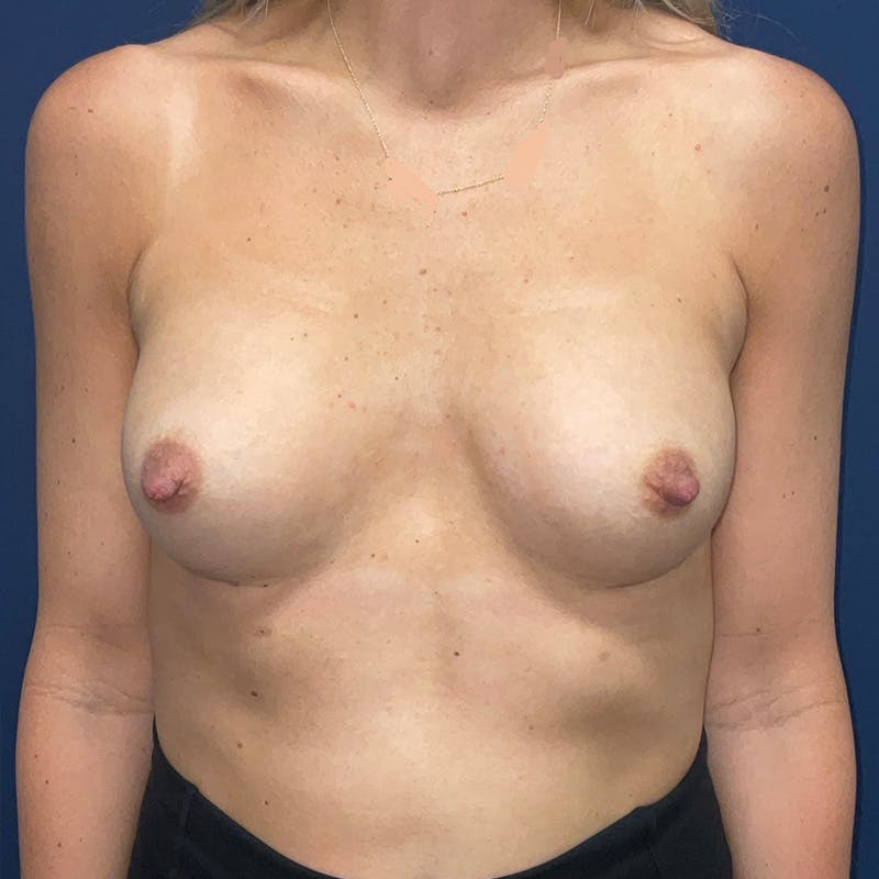 Breast Augmentation by Dr. Haydon Before & After Gallery - Patient 987721 - Image 2