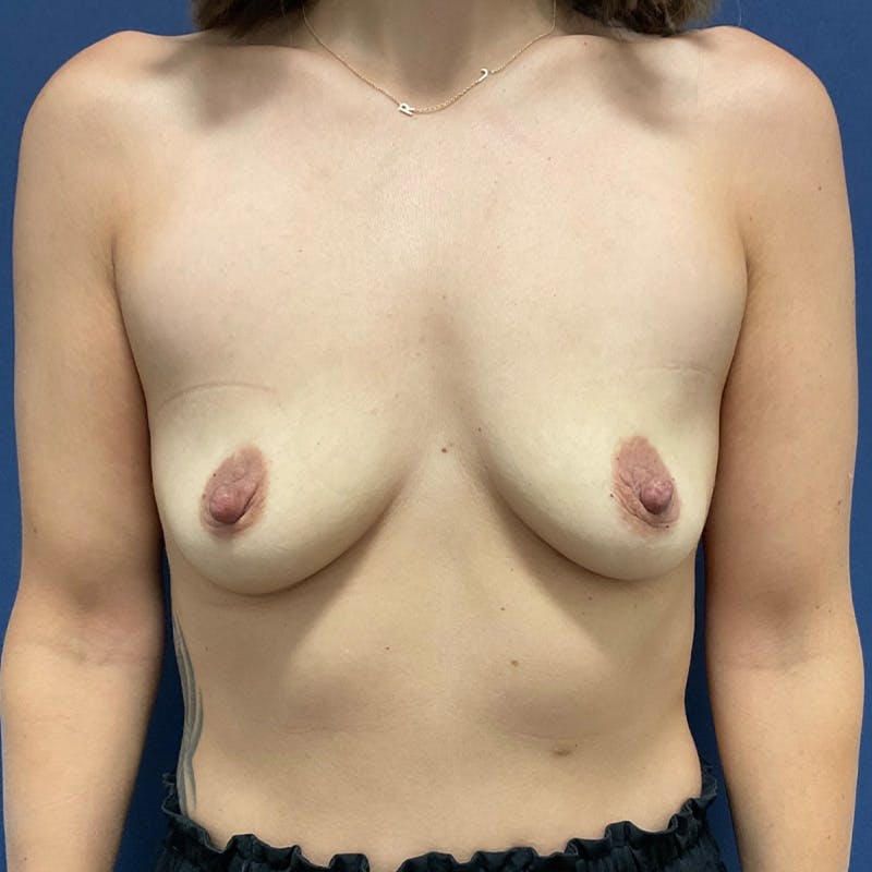 Breast Augmentation by Dr. Haydon Before & After Gallery - Patient 324751 - Image 1