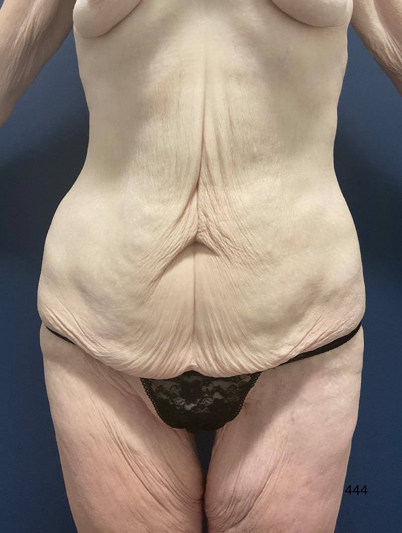 Tummy Tuck by Dr. Haydon Before & After Gallery - Patient 354017 - Image 1