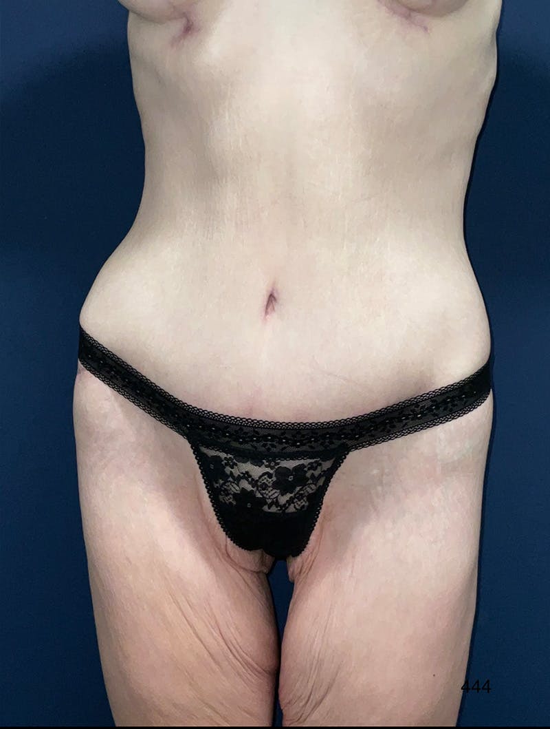 Tummy Tuck by Dr. Haydon Before & After Gallery - Patient 354017 - Image 2