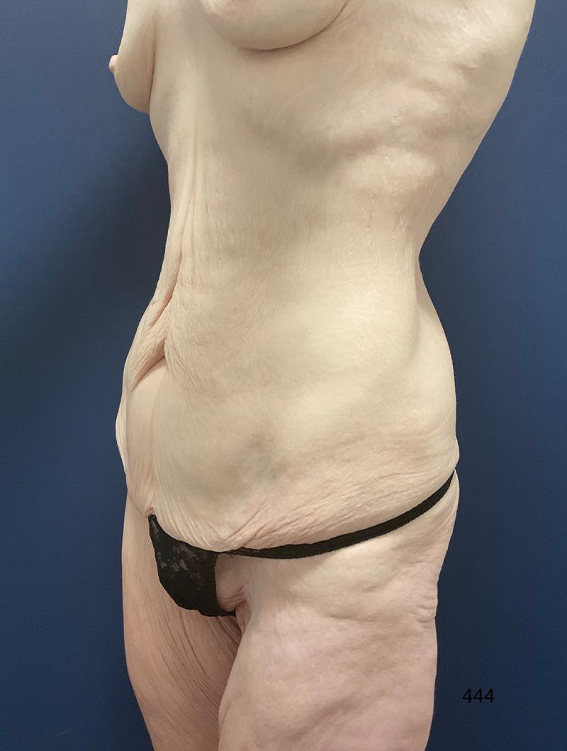 Tummy Tuck by Dr. Haydon Before & After Gallery - Patient 354017 - Image 3