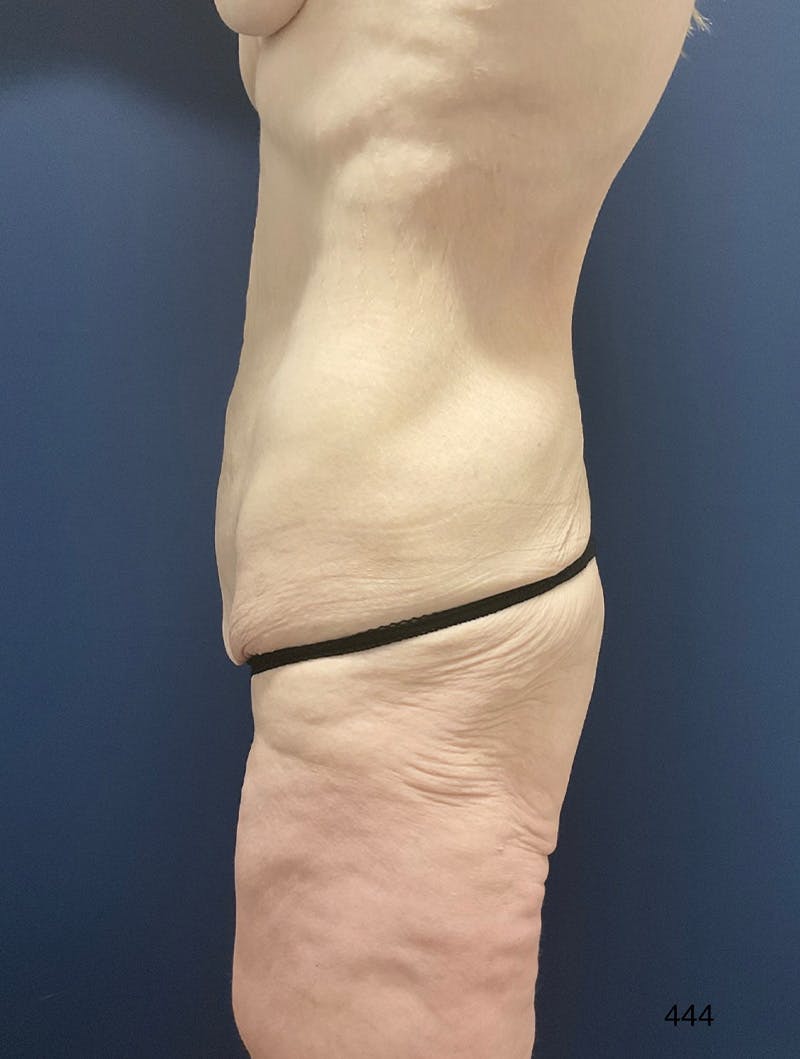 Tummy Tuck by Dr. Haydon Before & After Gallery - Patient 354017 - Image 5
