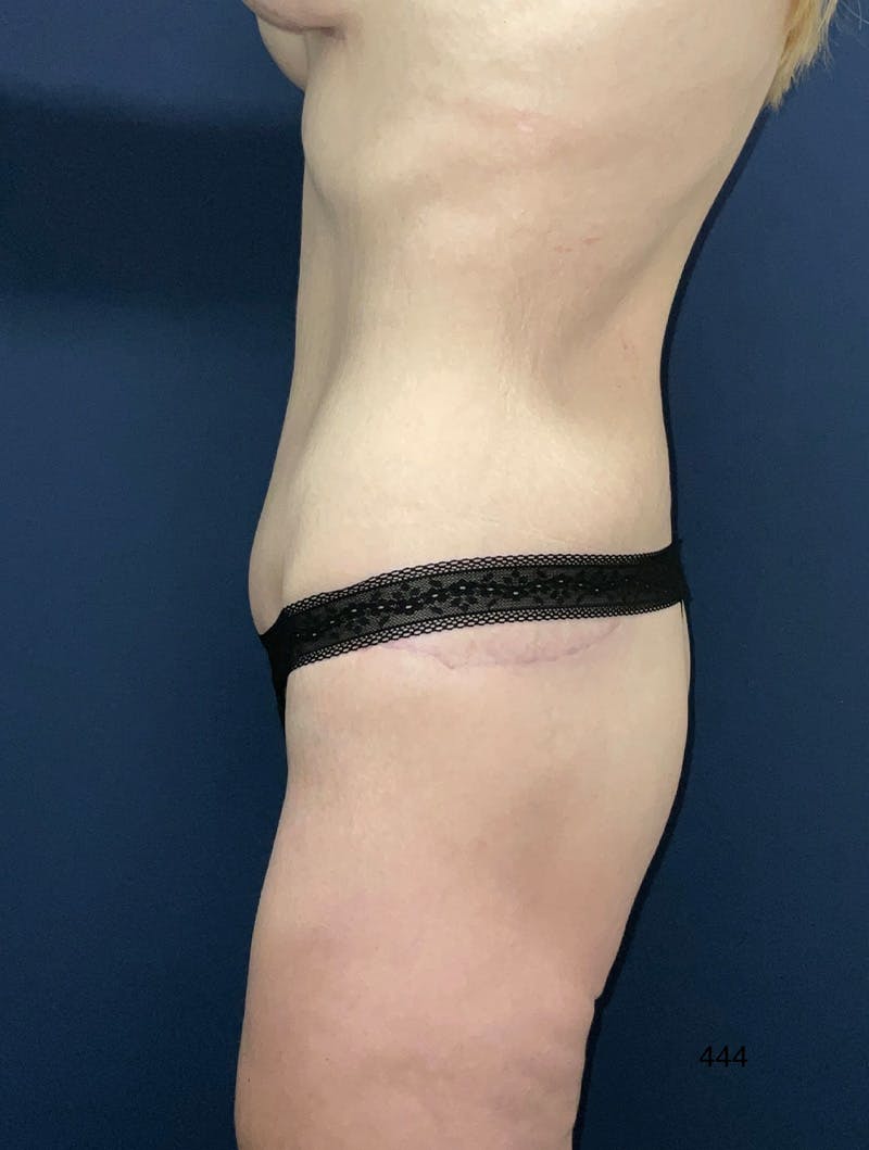 Tummy Tuck by Dr. Haydon Before & After Gallery - Patient 354017 - Image 6