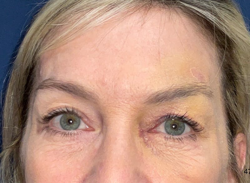 Eyelid Surgery by Dr. Haydon Before & After Gallery - Patient 273686 - Image 1