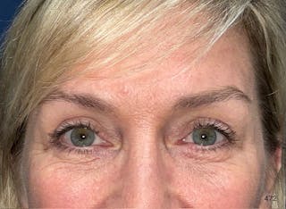 Eyelid Surgery by Dr. Haydon Before & After Gallery - Patient 273686 - Image 2