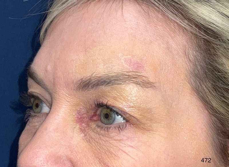 Eyelid Surgery by Dr. Haydon Before & After Gallery - Patient 273686 - Image 3