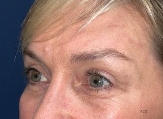Eyelid Surgery by Dr. Haydon Before & After Gallery - Patient 273686 - Image 4