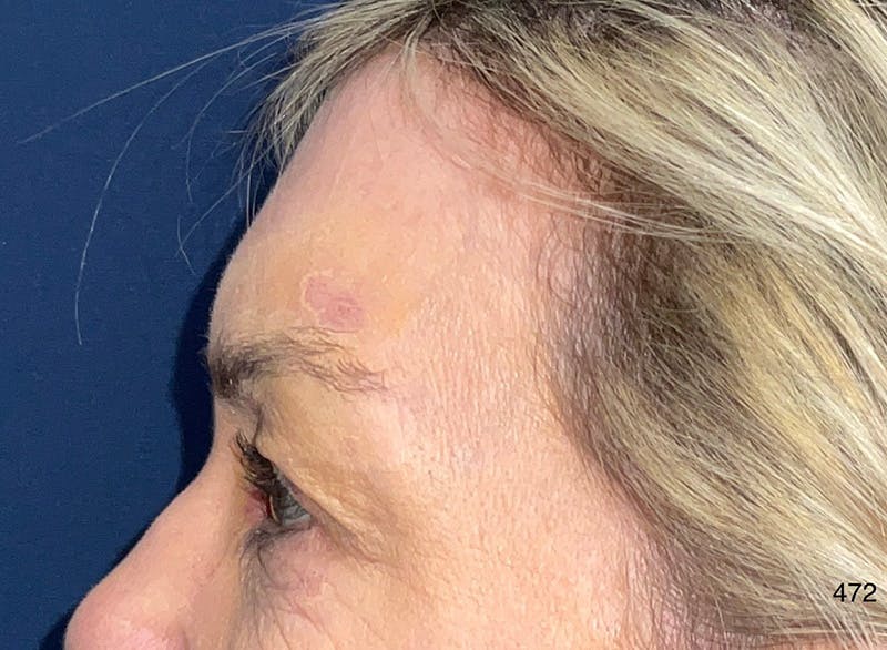 Eyelid Surgery by Dr. Haydon Before & After Gallery - Patient 273686 - Image 5