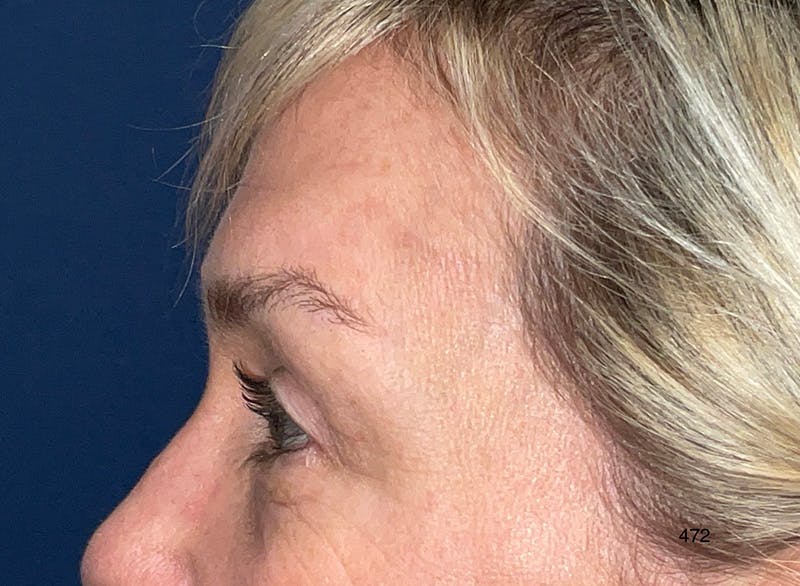 Eyelid Surgery by Dr. Haydon Before & After Gallery - Patient 273686 - Image 6