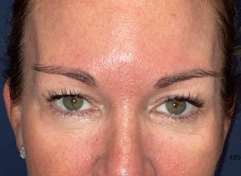 Eyelid Surgery by Dr. Haydon Before & After Gallery - Patient 233497 - Image 1