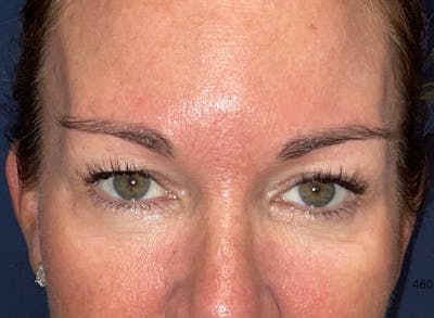Eyelid Surgery by Dr. Haydon Before & After Gallery - Patient 233497 - Image 1