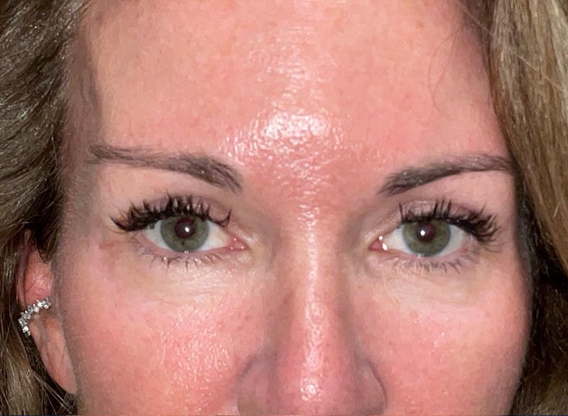 Eyelid Surgery by Dr. Haydon Before & After Gallery - Patient 233497 - Image 2