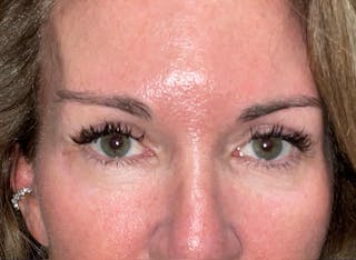 Eyelid Surgery by Dr. Haydon Before & After Gallery - Patient 233497 - Image 2