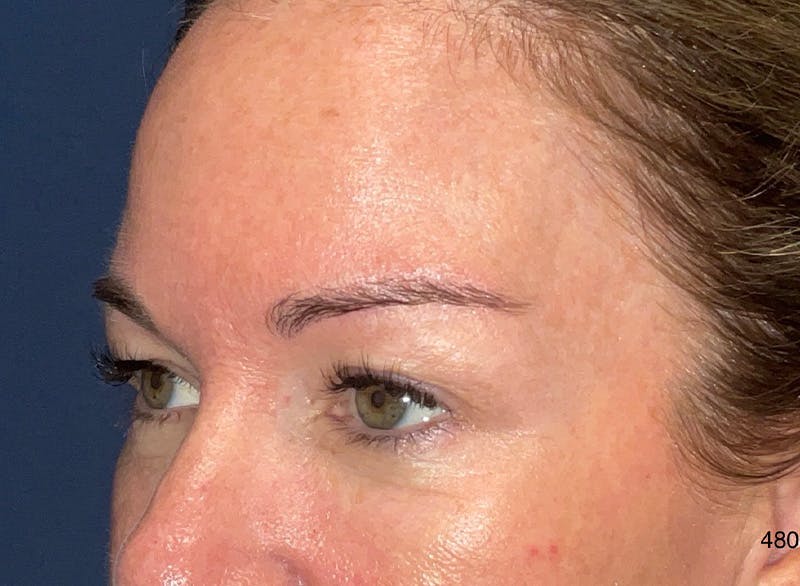 Eyelid Surgery by Dr. Haydon Before & After Gallery - Patient 233497 - Image 3