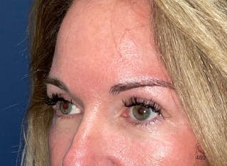 Eyelid Surgery by Dr. Haydon Before & After Gallery - Patient 233497 - Image 4
