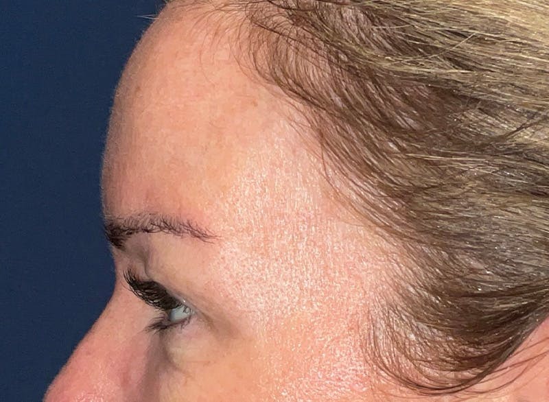 Eyelid Surgery by Dr. Haydon Before & After Gallery - Patient 233497 - Image 5