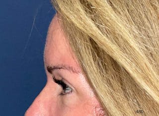 Eyelid Surgery by Dr. Haydon Before & After Gallery - Patient 233497 - Image 6