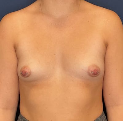 Breast Augmentation by Dr. Booth Before & After Gallery - Patient 493463 - Image 1