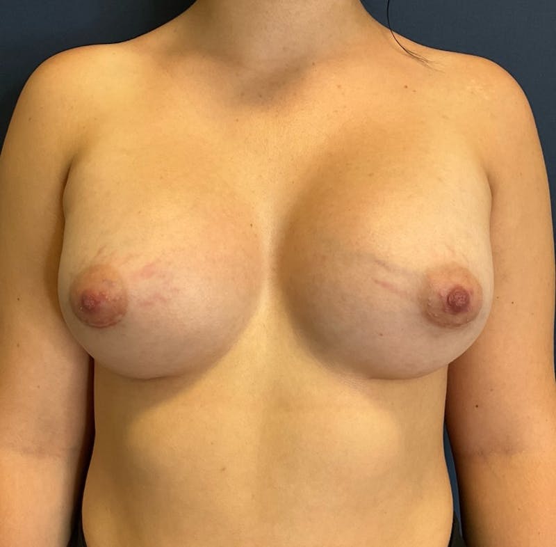Breast Augmentation by Dr. Booth Before & After Gallery - Patient 493463 - Image 2