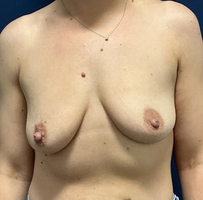 Breast Augmentation by Dr. Booth Before & After Gallery - Patient 427043 - Image 1