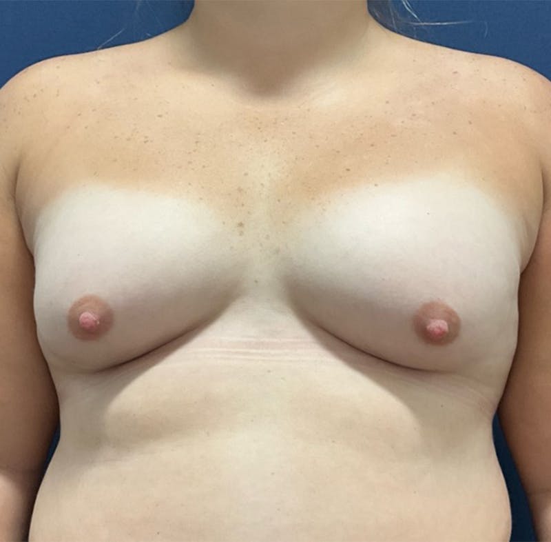 Breast Augmentation by Dr. Booth Before & After Gallery - Patient 208368 - Image 1