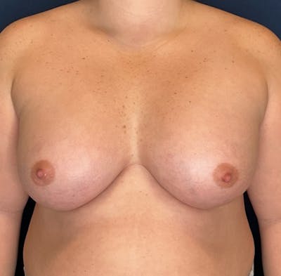 Breast Augmentation by Dr. Booth Before & After Gallery - Patient 208368 - Image 2
