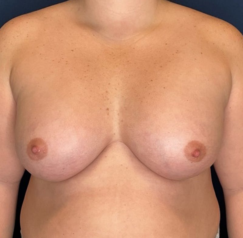 Breast Augmentation by Dr. Booth Before & After Gallery - Patient 208368 - Image 2