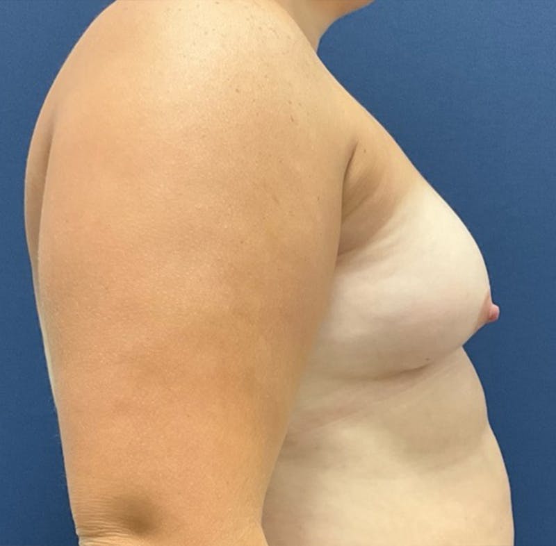 Breast Augmentation by Dr. Booth Before & After Gallery - Patient 208368 - Image 5