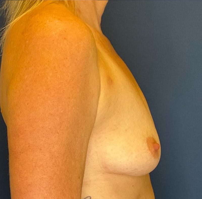 Breast Augmentation by Dr. Booth Before & After Gallery - Patient 739940 - Image 5