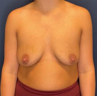 Breast Augmentation by Dr. Booth Before & After Gallery - Patient 364125 - Image 1