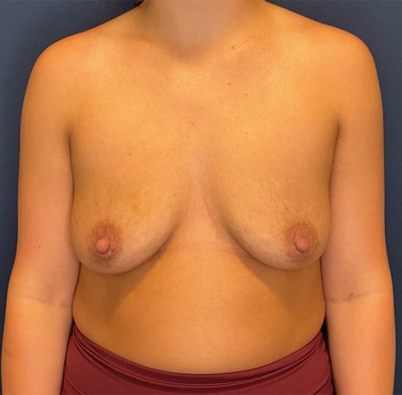 Breast Augmentation by Dr. Booth Before & After Gallery - Patient 364125 - Image 1