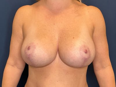  Breast Lift with Augmentation Dr. Booth Before & After Gallery - Patient 300480 - Image 2