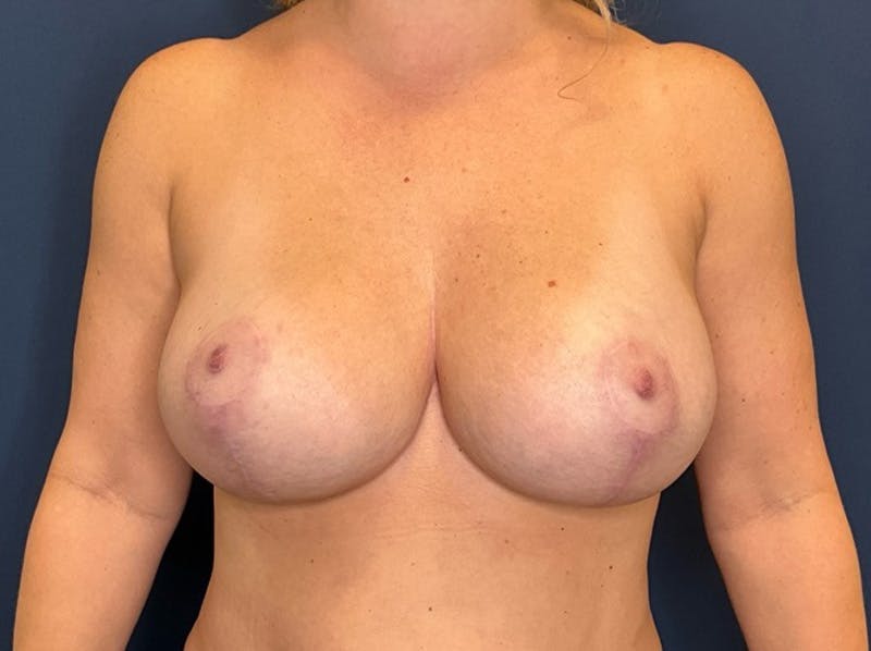 Breast Lift with Augmentation Dr. Booth Before & After Gallery - Patient 300480 - Image 2